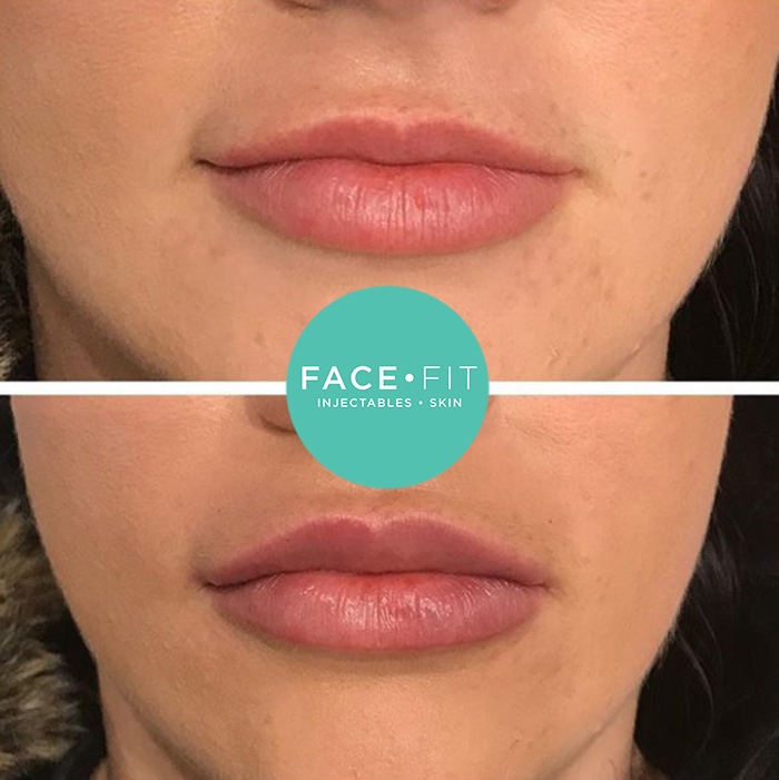 lip injections before and after thin lips