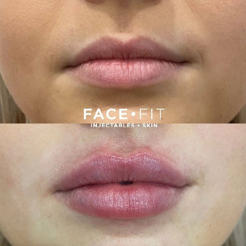 Lip Injectables Before and After photo Gold Coast