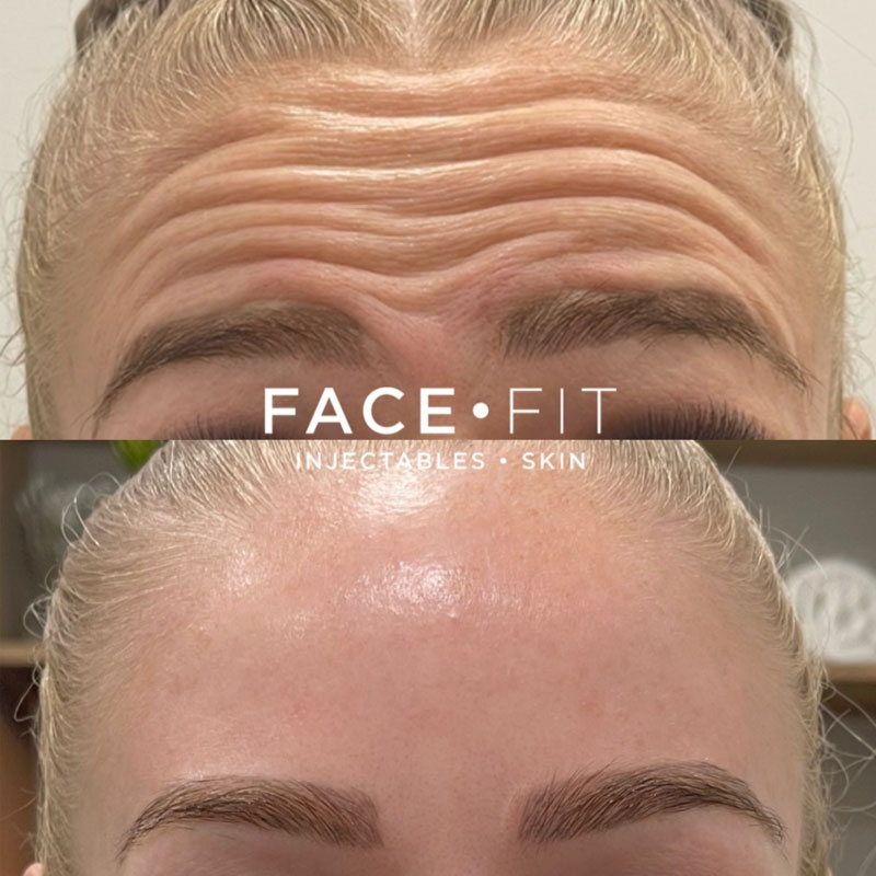 Cosmetic Injectables Before and After photo Gold Coast