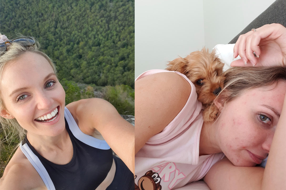 Ashleigh's fabulous results treating acne