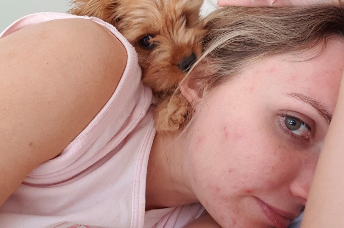 Ashleigh on her pimple and supermarket skincare journey