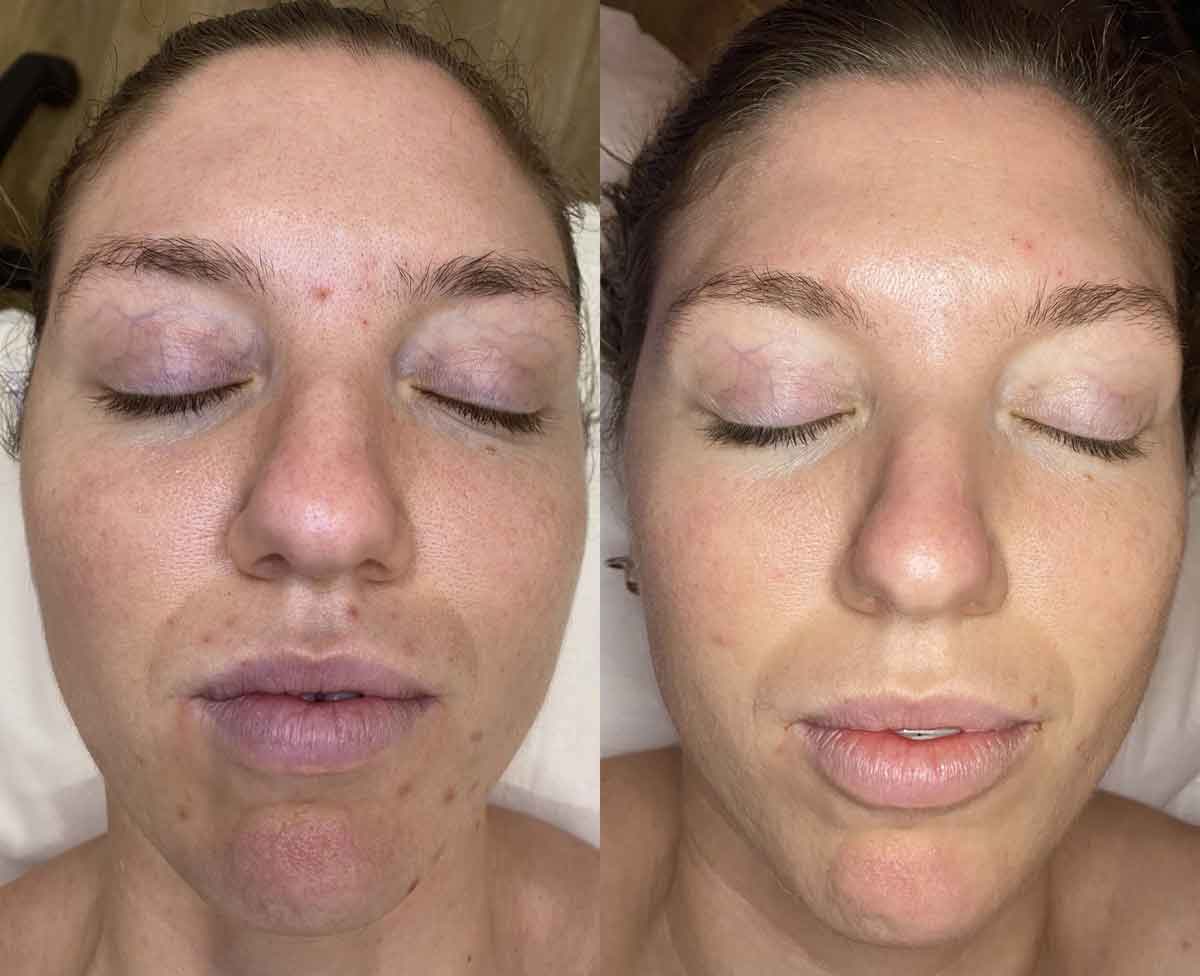 Managing Hormonal Breakouts with Face Fit - Ash's before and after photo