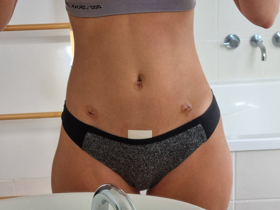 Face Fit Clinic Manager and Dermal Therapist, Ashleigh on her road to recovery following her Endometriosis surgery