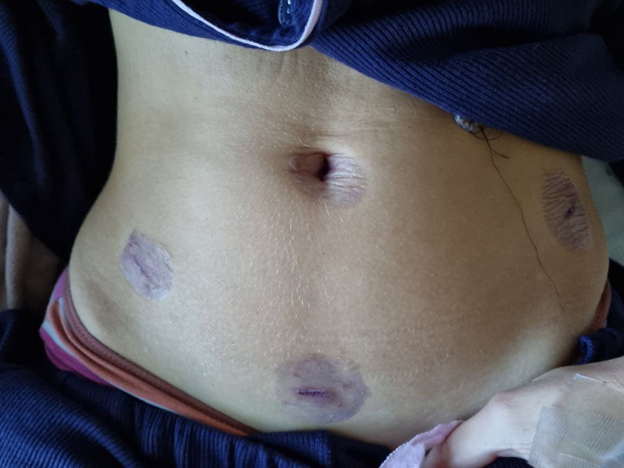 closeup of Ash's tummy following endo treatment