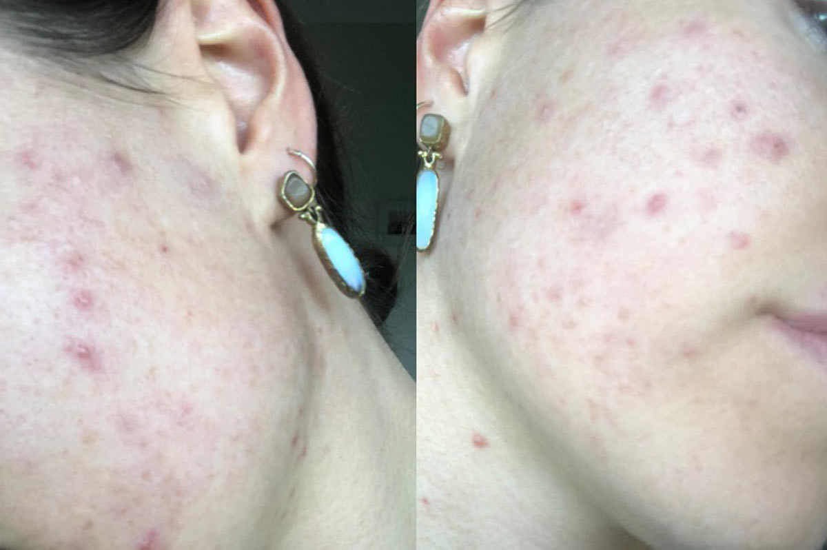 Evie had acne breakouts
